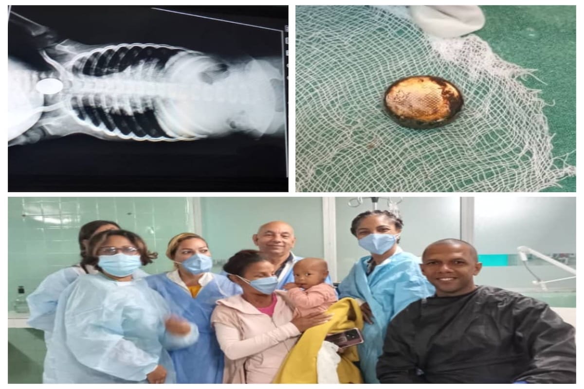 Niña de un año es intervenida de urgencia en Santiago de Cuba tras ingerir una batería de litio